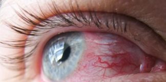 Lente de contato aumenta em cinco vezes risco de alergias oculares