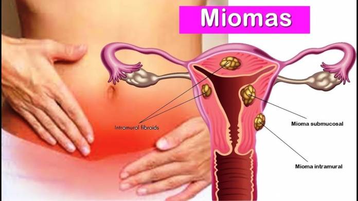 miomas