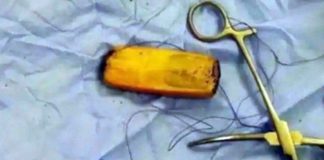 Homem engole celular e espera 6 meses para procurar médico e retirá-lo