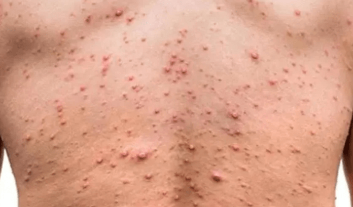 Entenda o surto de mpox na África que preocupa a OMS Entenda o surto de mpox na África que preocupa a OMS