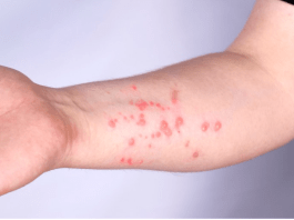 Mpox: OMS volta a declarar emergência em saúde pública global