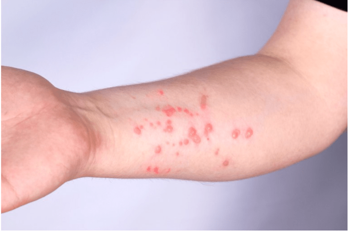 Mpox: OMS volta a declarar emergência em saúde pública global