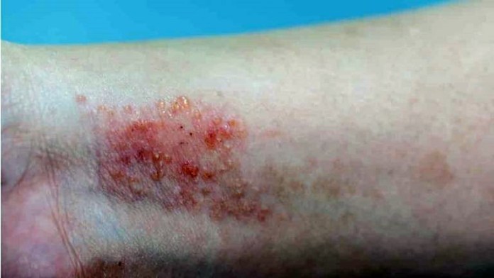 Dica-dermatite-atopica-768x432 Doença não contagiosa, a dermatite atópica é uma condição genética e crônica, caracterizada principalmente por coceira intensa e pele ressecada