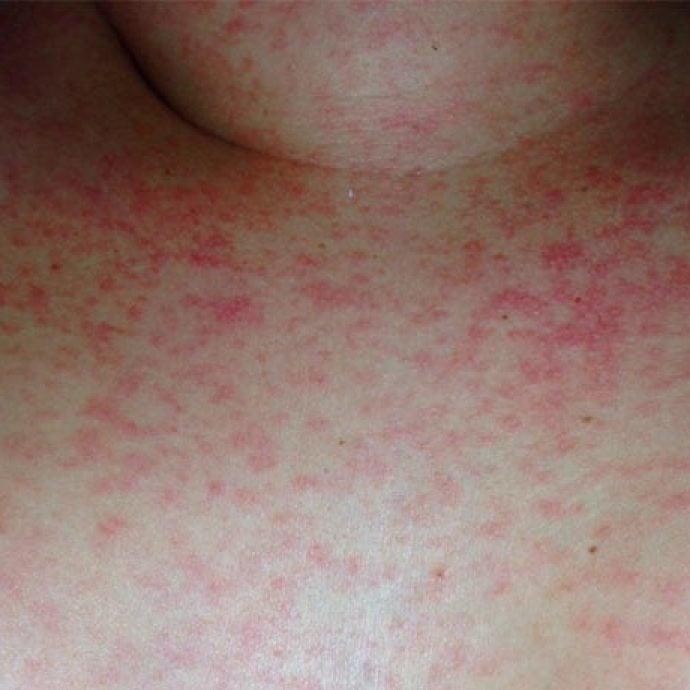 Surto de escarlatina em São Carlos