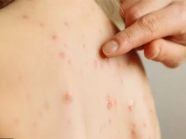 Estado de São Paulo confirma segundo caso de sarampo em 2025