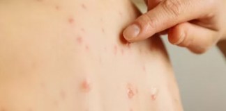 Estado de São Paulo confirma segundo caso de sarampo em 2025