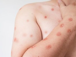 Ribeirão Preto confirma dois casos de mpox