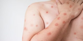 Ribeirão Preto confirma dois casos de mpox Ribeirão Preto confirma dois casos de mpox