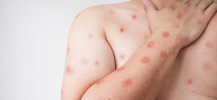 mpox 7 Ribeirão Preto confirma dois casos de mpox