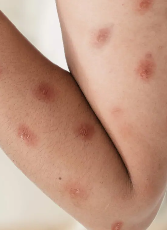 A Prefeitura de Araraquara, por meio da Secretaria Municipal de Saúde, confirmou nesta terça-feira a existência de um caso de MPOX no município.