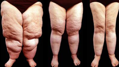 Pesquisadores do IFSC/USP abrem segunda chamada para tratamento experimental de lipedema Pesquisadores do IFSC/USP abrem segunda chamada para tratamento experimental de lipedema